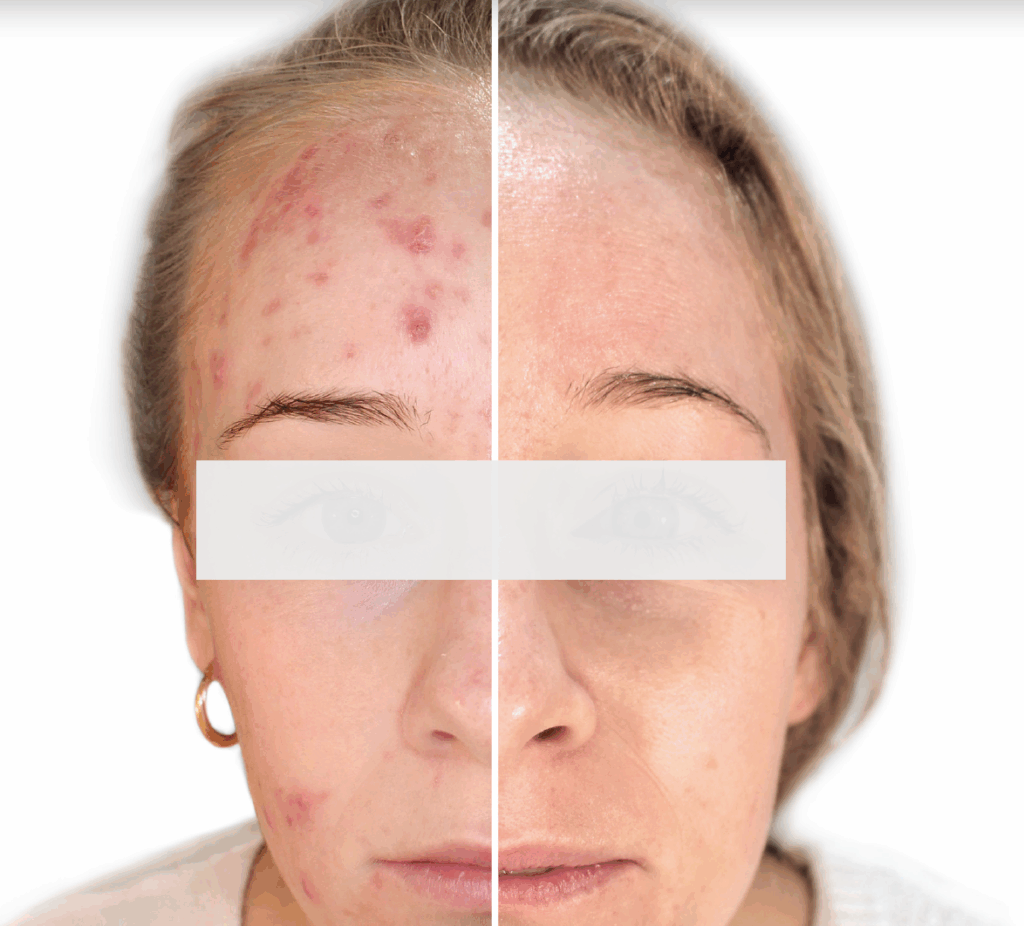 Inflammation and acne resolved by Kleresca Acne Treatment