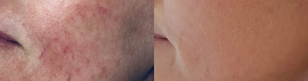 Best Treatments for Acne and Rosacea-Prone Skin