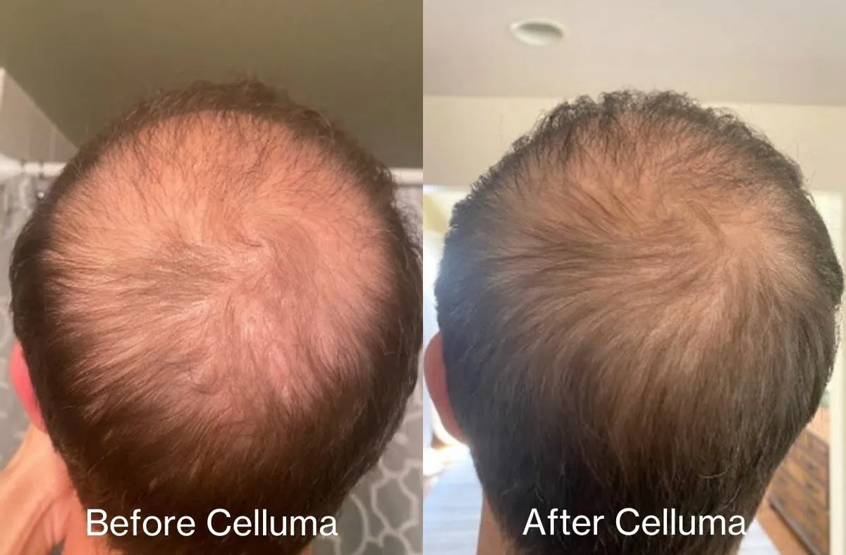 Celluma Hair Growth Before After Male Back Head